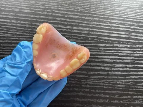 Upper Palatal View Of Used Denture With Tartar And Stains Stock Photos