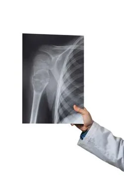 The upper part of the humerus after bone augmentation, X-ray Stock Photos