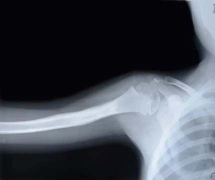 The upper part of the humerus Stock Photos