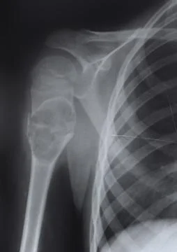 The upper part of the humerus Stock Photos
