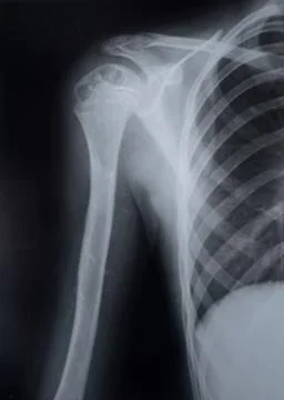 The upper part of the humerus Stock Photos