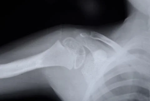 The upper part of the humerus Stock Photos