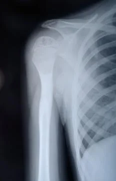 The upper part of the humerus Stock Photos