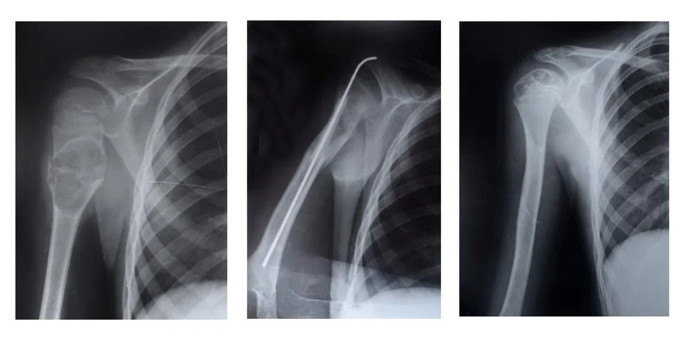 The upper part of the humerus Stock Photos
