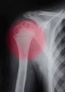The upper part of the humerus Stock Photos