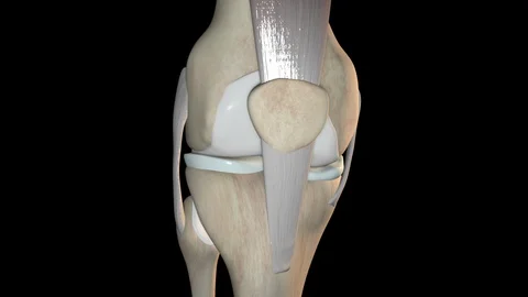 Upper Pole Patella Fracture Stock Footage 122381266