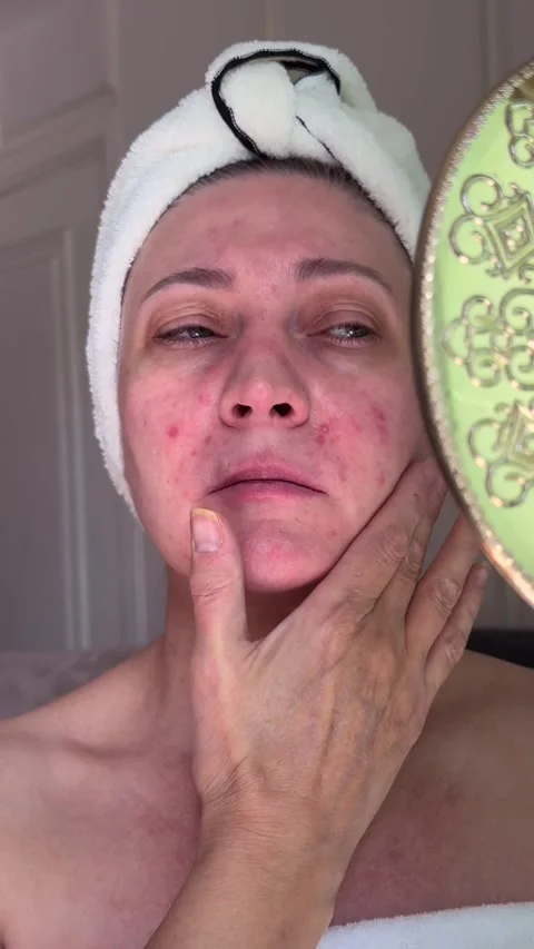 Upset middle aged woman with sensitive irritated skin applies hand to face Video stock 337104948