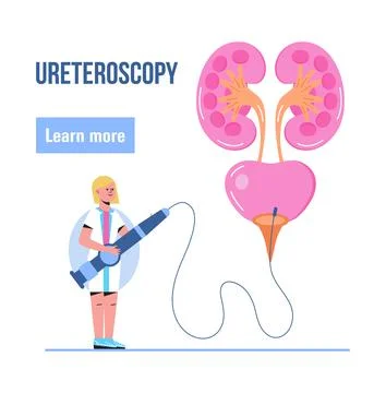 Ureteroscopy concept vector for medical website. Urologist, nephropathy illus 스톡 일러스트