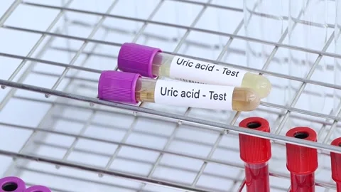 Uric acid test to look for abnormalities... | Stock Video | Pond5