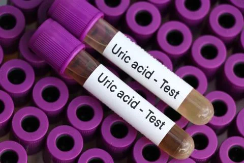 Uric acid test to look for abnormalities from Urine,  Urine sample to analy.. Stockfoto's