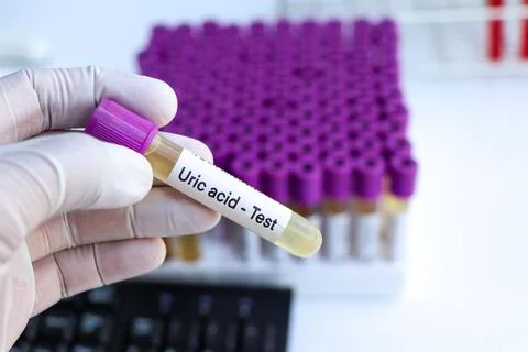 Uric acid test to look for abnormalities from Urine,  Urine sample to analy.. Stockfoto's
