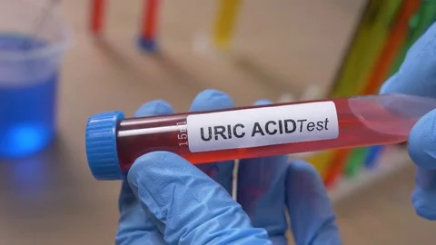 Positive Uric Acid Test, Doctor Shows Blood Sample, Lab Research