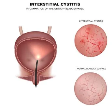 Urinary bladder lining Stock Illustration