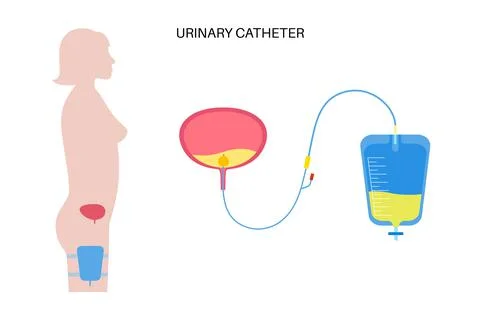 Urinary drainage bag Stock Illustration