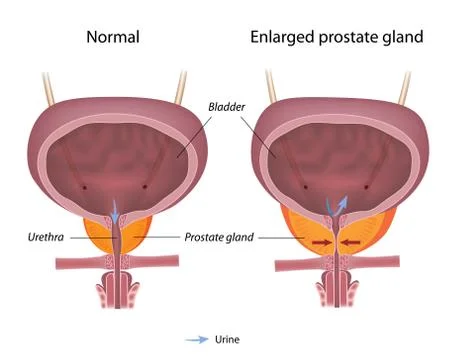 Urinary incontinence due to benign prostatic hyperplasia Illustrazione stock
