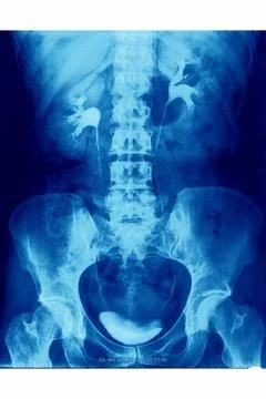  Urinary system, x-ray finding Urinary system, frontal view. Copyright: xC... Stock Photos