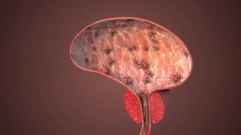 Urinary Tract Infection Originating in Bladder Stock Footage 306926718