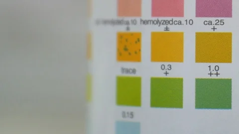 Urine analysis in laboratory colour level chemical in urine. Video stock 108249434
