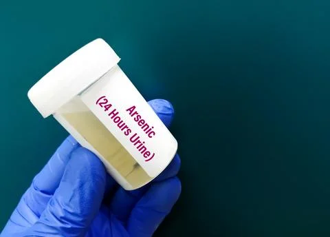 Urine sample for 24 hours urinary Arsenic testing to diagnose arsenic toxicity. Foto stock