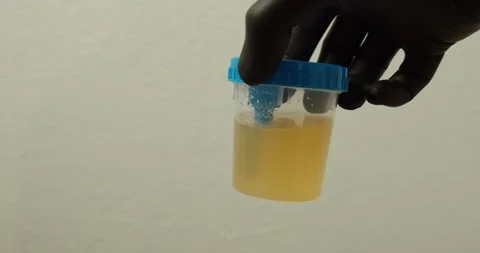 Urine Sample Handling with Gloves – Safe Medical Testing Practice Stock Footage 334712697