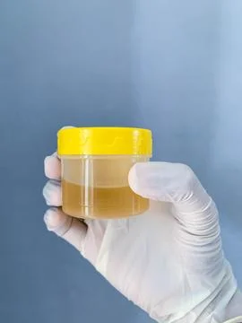 A urine sample is held in the hand of a man wearing white medical gloves Stock Photos