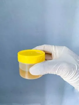 A urine sample is held in the hand of a man wearing white medical gloves Stock-Fotos