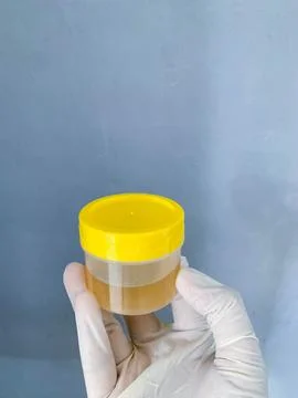 A urine sample is held in the hand of a man wearing white medical gloves Stock Photos