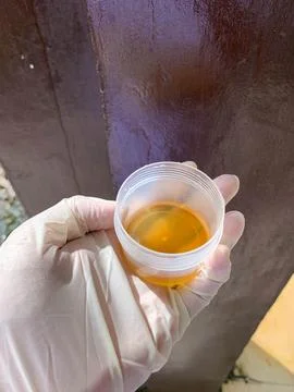 A urine sample is held in the hand of a man wearing white medical gloves Stock Photos