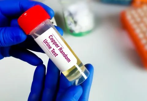 Urine sample for Random urinary copper test to diagnose copper toxicity. 스톡 사진