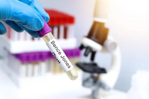 Urine samples for testing Bence Jones in the laboratory Stockfoto's