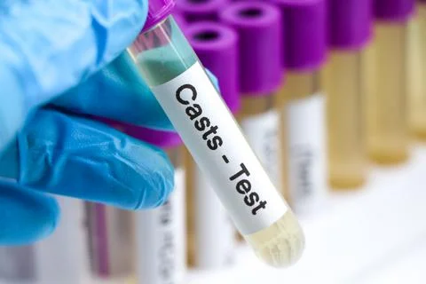 Urine samples for testing Casts in the laboratory Stock Photos