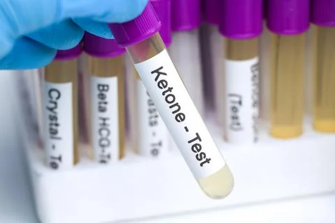 Urine samples for testing Ketones in the laboratory Stock Photos