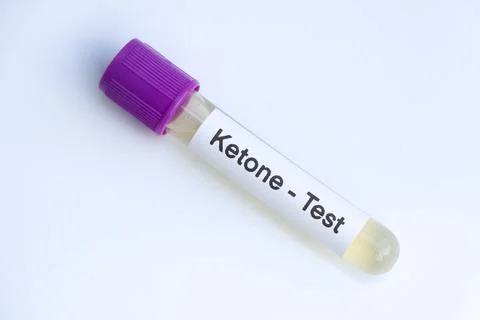 Urine samples for testing Ketones in the laboratory Stock Photos