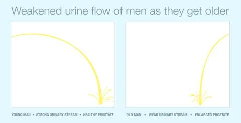 Urine Stream Enlarged Prostate Weak Strong Urinary Flow Young Old Man Stock Illustration