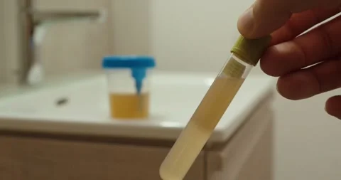 Urine Test Strip Analysis – Bacteria Detection in Sample 動画素材 334363602