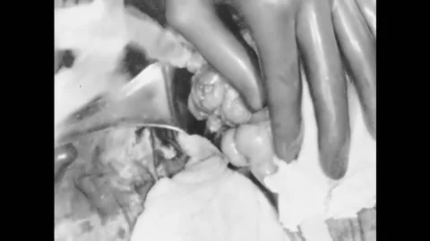 USA - 1930s - The stump of a removed appendix is inverted in an appendectomy. Видео 261705066