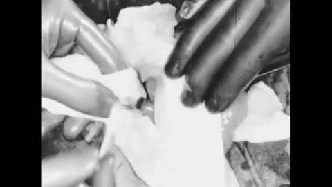 USA - 1930s - The stump of a removed appendix is cauterized during an 스톡 동영상 261705179
