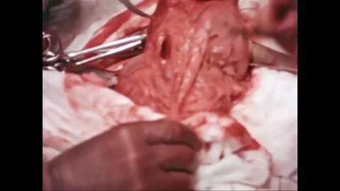 USA - 1950s - Forceps and scissors are used during a gastrectomy. Stock Footage 261705216