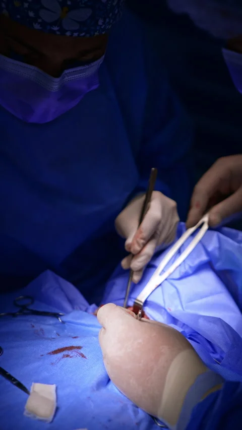 Usage of modern electric devices and metal tools at thyroid surgery. Video stock 281375884