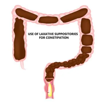 Use of laxatives rectal suppositories for constipation. Feces in colon Stock Illustration