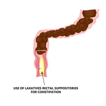 Use of laxatives rectal suppositories for constipation. Feces in colon Stock Illustration
