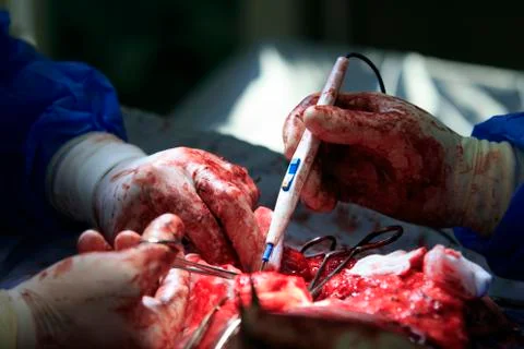 Using coagulator Photos