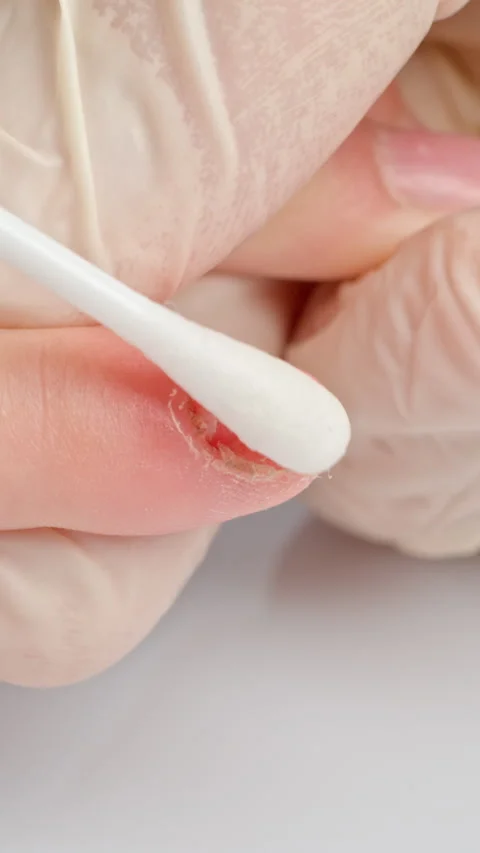 Using cotton swab for damaged nail care close up vertical video Stock Footage 330521247