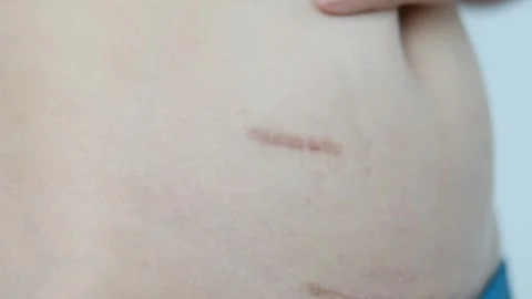 Using cream to care for scars after appendix surgery Stock Footage 253407667