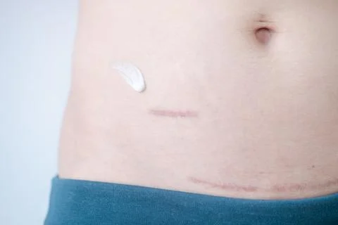 Using cream to care for scars after appendix surgery and postpartum surgica.. Stock Photos