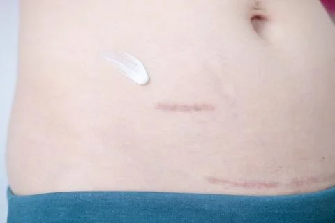 Using cream to care for scars after appendix surgery and postpartum surgica.. Stock Photos