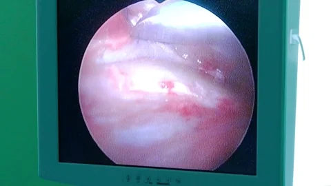 Using an endoscope, the doctor performs an operation on the face of a person Stock Footage 72566284