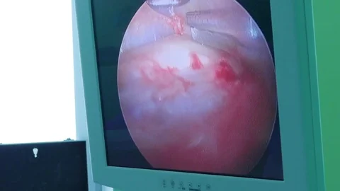 Using an endoscope, the doctor performs an operation on the face of a person Video stock 72566305