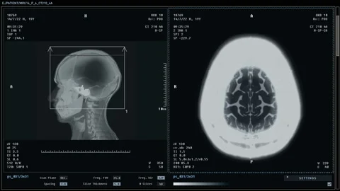 Using Modern Medical Imaging Scanner Device For Brain Illness Diagnosis Video stock 219503121