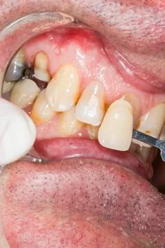 Using a shade guide to check veneer of tooth crown Stock Photos